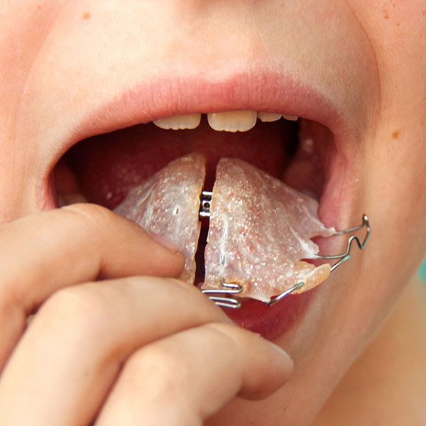 Upper Removable Appliance