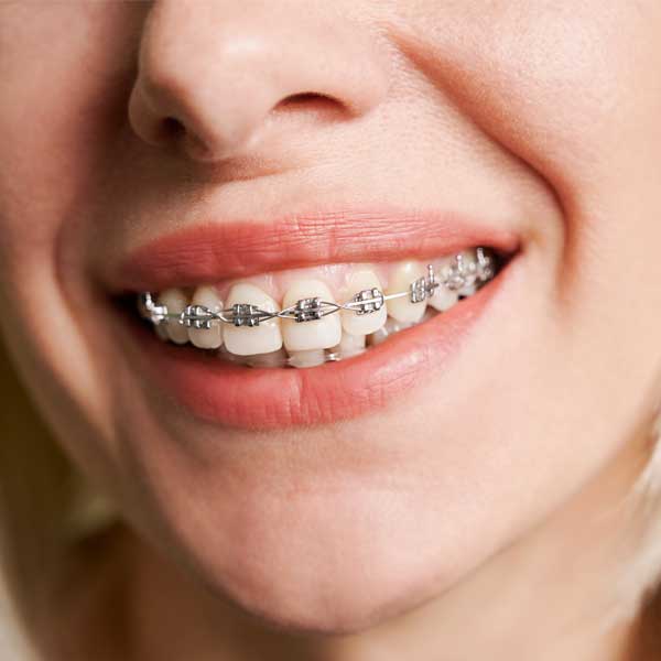 metal braces